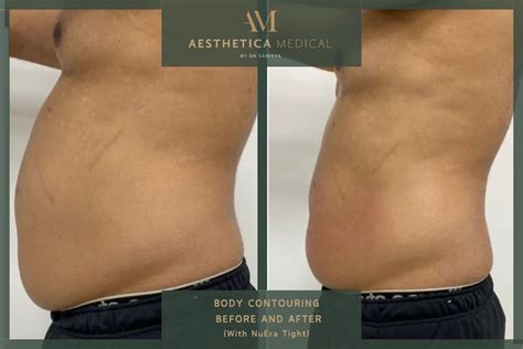 Does Body Contouring Help Cellulite