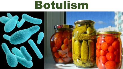 does botulism have a cure