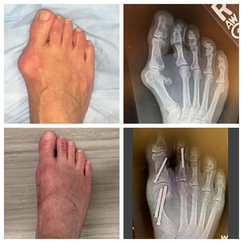 Does Bunion Surgery Correct Hammer Toe