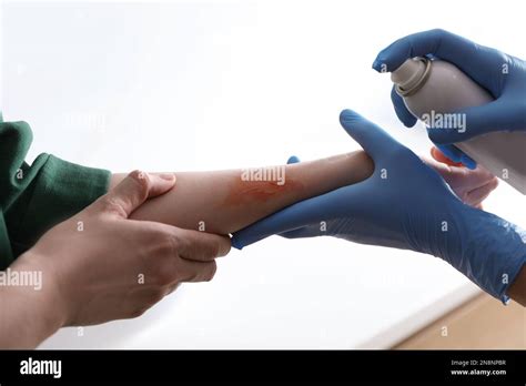 Does Burn Spray Work