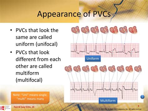 Does Calcium Cause Pvcs