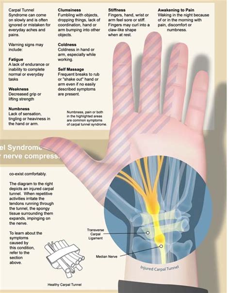 Does Carpal Tunnel Affect Grip Strength