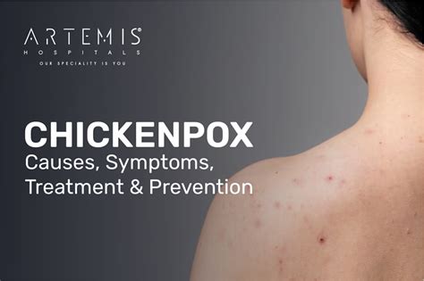 Does Chickenpox Affect Pregnancy