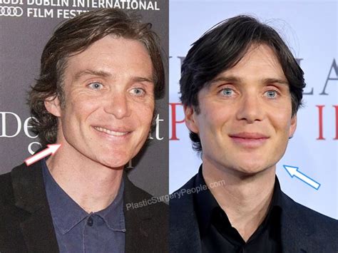 does cillian murphy have botox