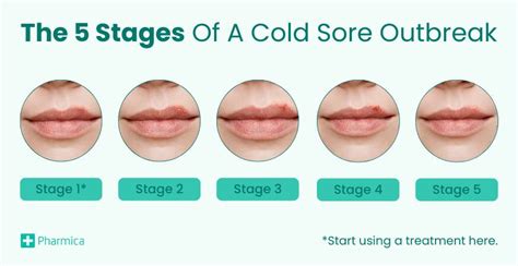 Does Cold Sore Virus Live On Surfaces