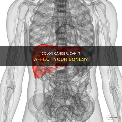 Does Colon Cancer Affect Bones