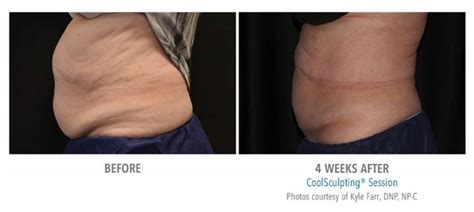 does coolsculpting really freeze fat