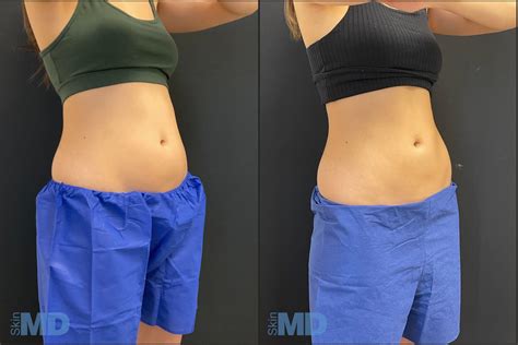 does coolsculpting result in weight loss