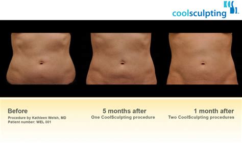 does coolsculpting work reviews