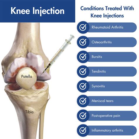 does cortisone injections help with arthritis
