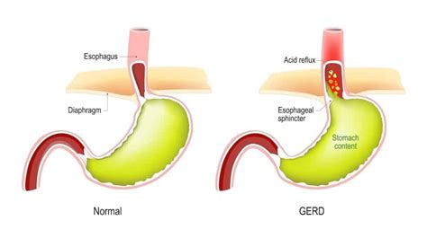 Does Cough Drops Help Acid Reflux