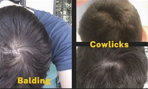 does cowlick mean balding
