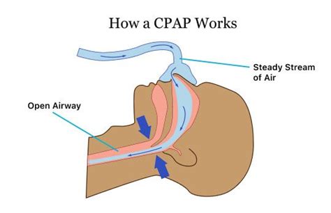 Does Cpap Work With Stuffy Nose