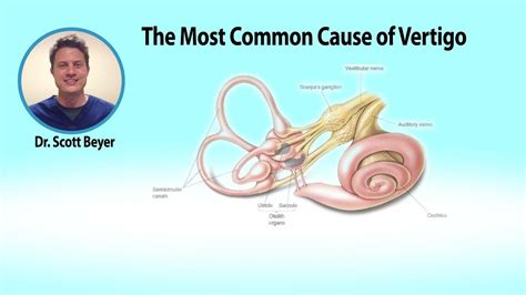 Does Cushing Syndrome Cause Vertigo