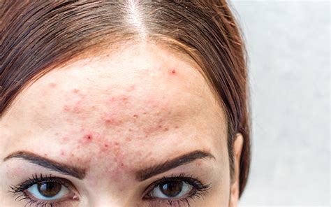 Does Dandruff Cause Pimples On Forehead