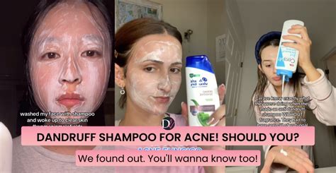 Does Dandruff Shampoo Help Acne