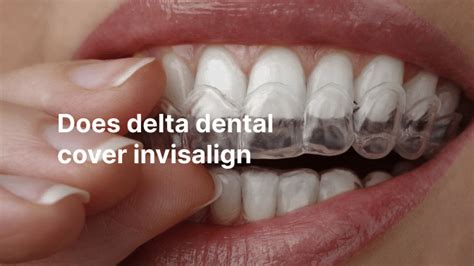 does delta dental cover invisalign