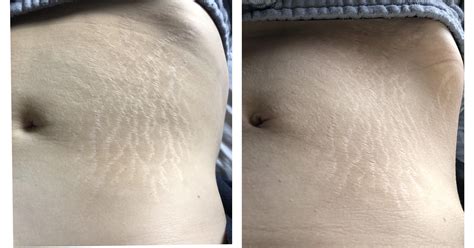 Does Derma Rolling Work On Old Stretch Marks