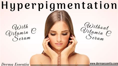 Does Drinking Vitamin C Help Hyperpigmentation