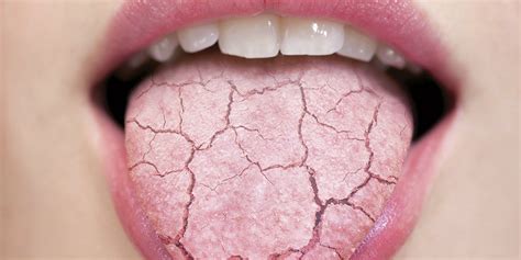 Does Dry Mouth Affect Your Lips