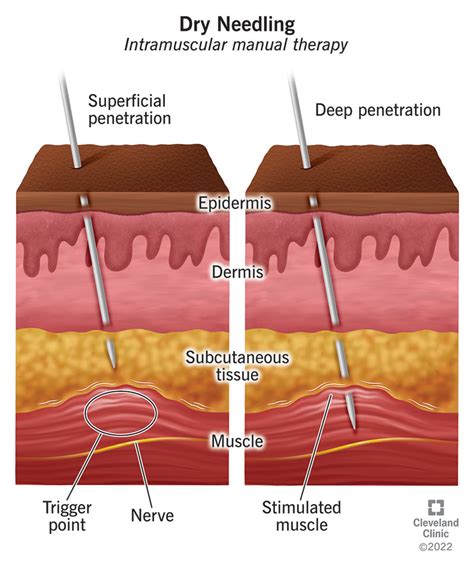 Does Dry Needling Cause Scar Tissue