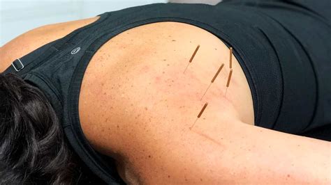 Does Dry Needling Help Shoulder Impingement