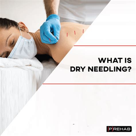 Does Dry Needling Help With Migraines