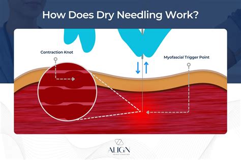 Does Dry Needling Work For Neuropathy