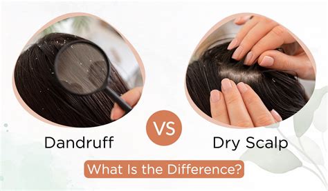 Does Dry Shampoo Remove Dandruff