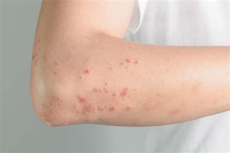 does dust affect eczema