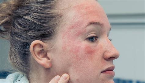 does eczema spread on face
