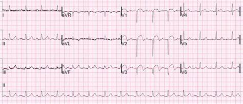 Laporan Kasus Stroke Hemoragik