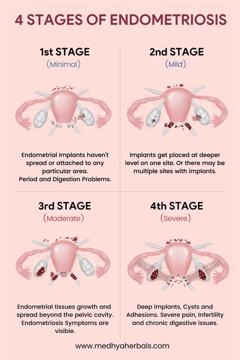 does endometriosis have stages