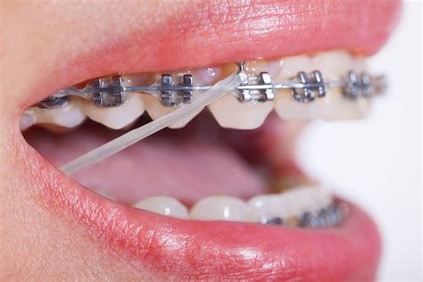 does everyone need rubber bands for braces