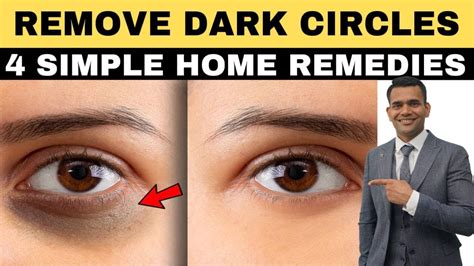 Does Exercise Get Rid Of Dark Circles