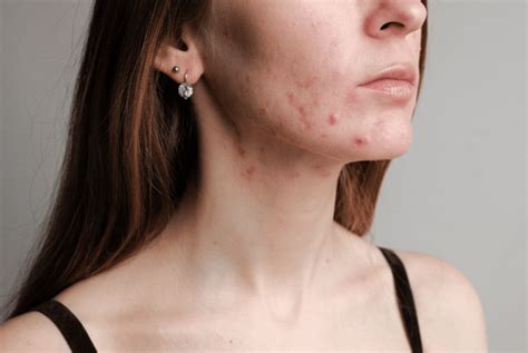 Does Exercise Help Acne? Exploring the Relationship Between Physical Activity and Clear Skin
