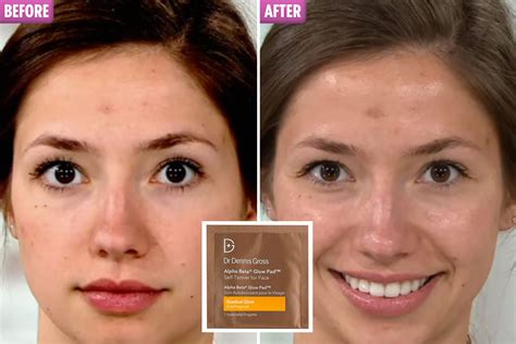 Does Fake Tan Help Acne