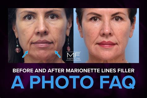 does filler help marionette lines