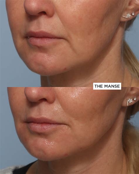 Does Filler Help With Jowls