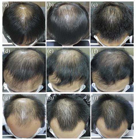 Unlocking Hair Restoration: Unveiling the Efficacy of Finasteride and Minoxidil