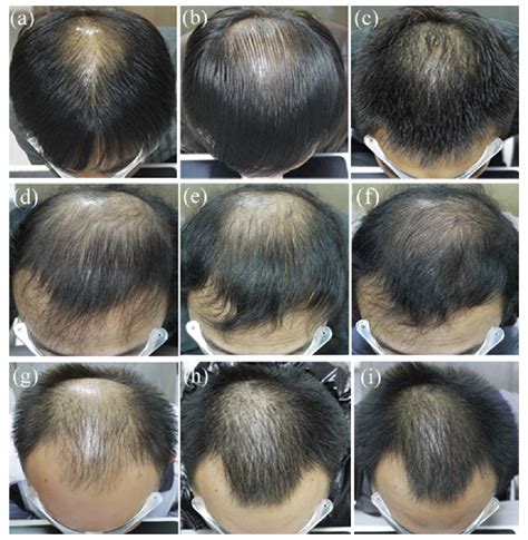 does finasteride and minoxidil work