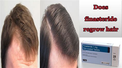 does finasteride really work