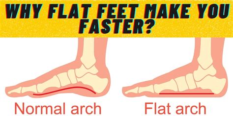 Does Flat Feet Make You Faster