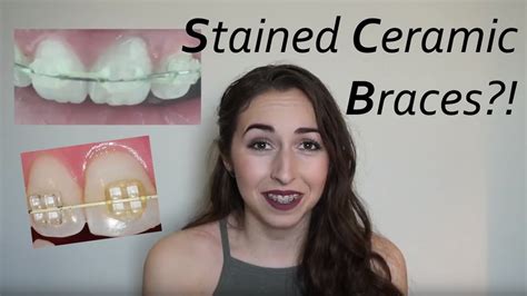 does food stain ceramic braces