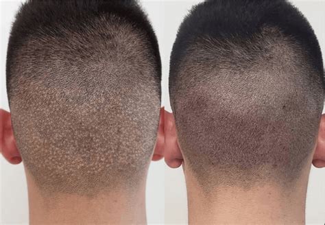 does fue hair transplant leave scars