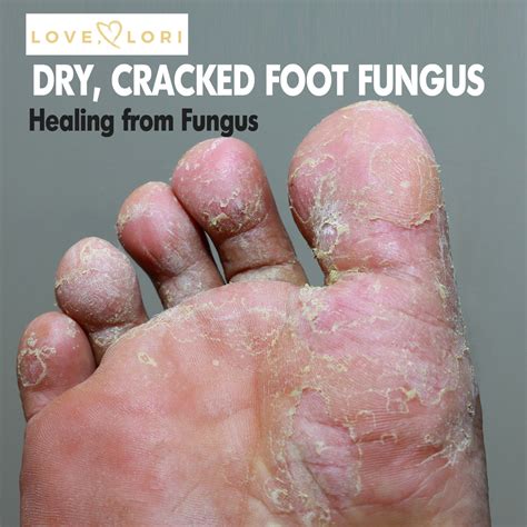 Does Garlic Kill Foot Fungus