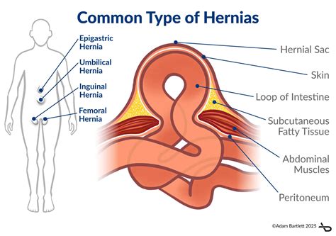 Does Golf Cause Hernias
