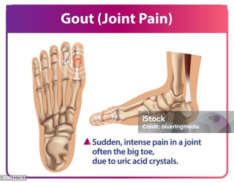 Does Gout Affect All Your Joints
