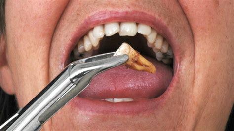does gum disease go away when teeth are removed