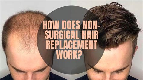 does hair replacement therapy work